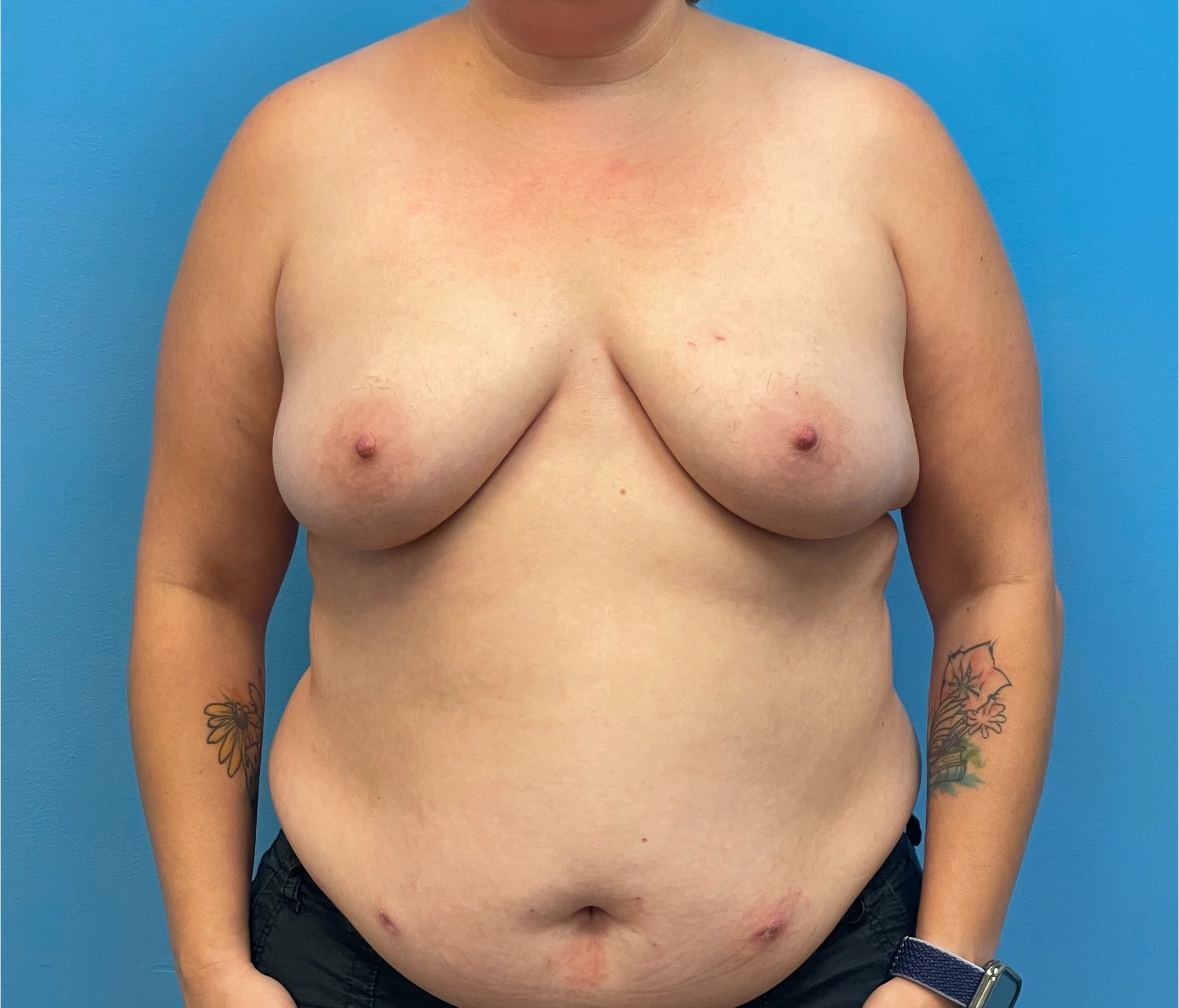 DIEP-Flap-Case--28021 | Before DIEP Flap 1