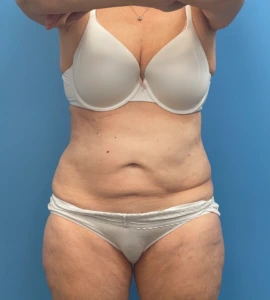 Abdominoplasty-Case--23690 | Before Liposuction 1
