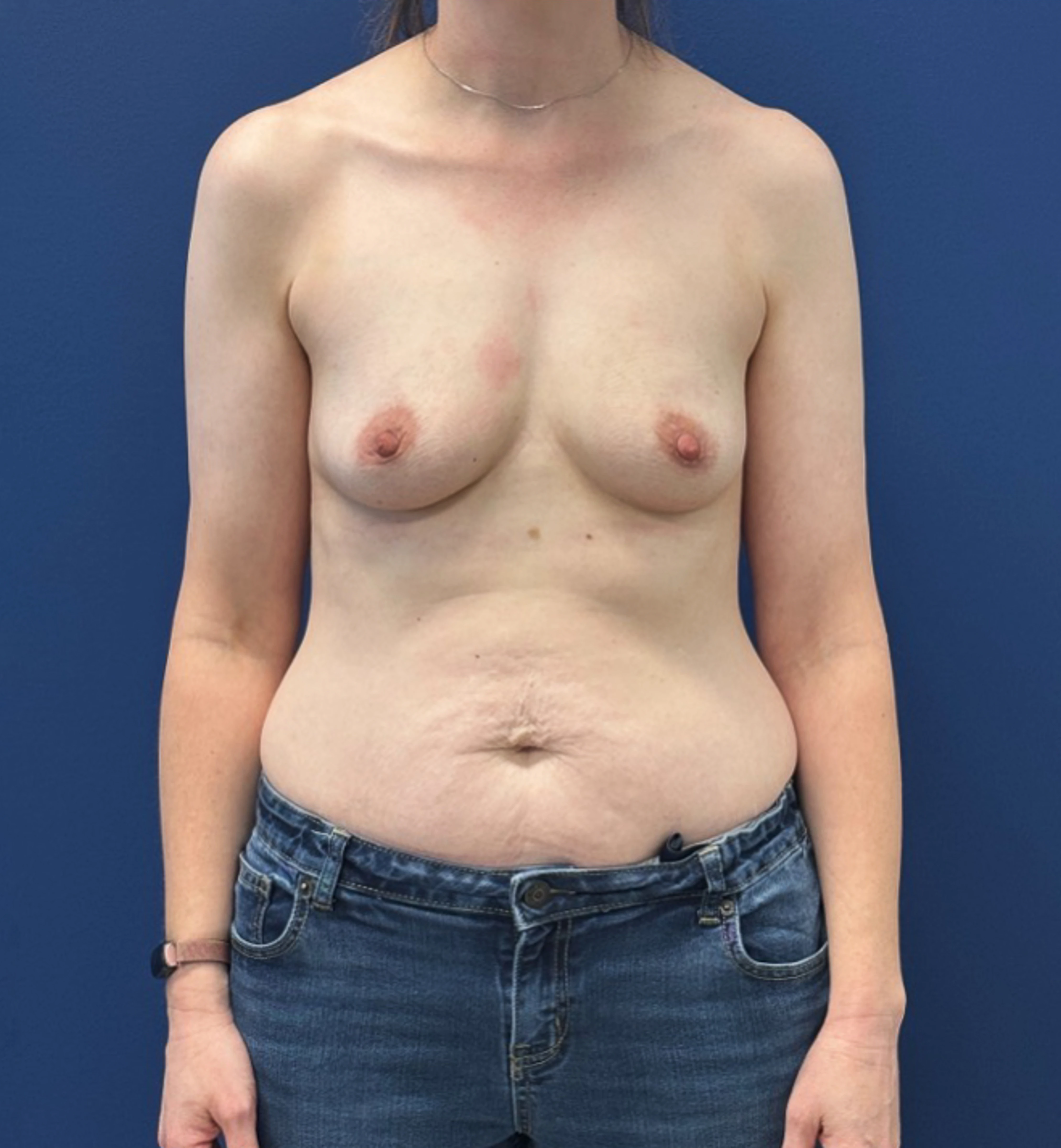 Breast-Augmentation-Case--28670 | Before Breast Augmentation 1
