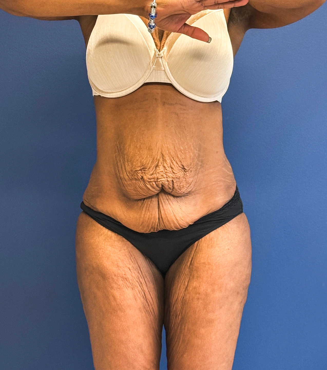 Tummy-Tuck-Case--28714 | Before Tummy Tuck 1