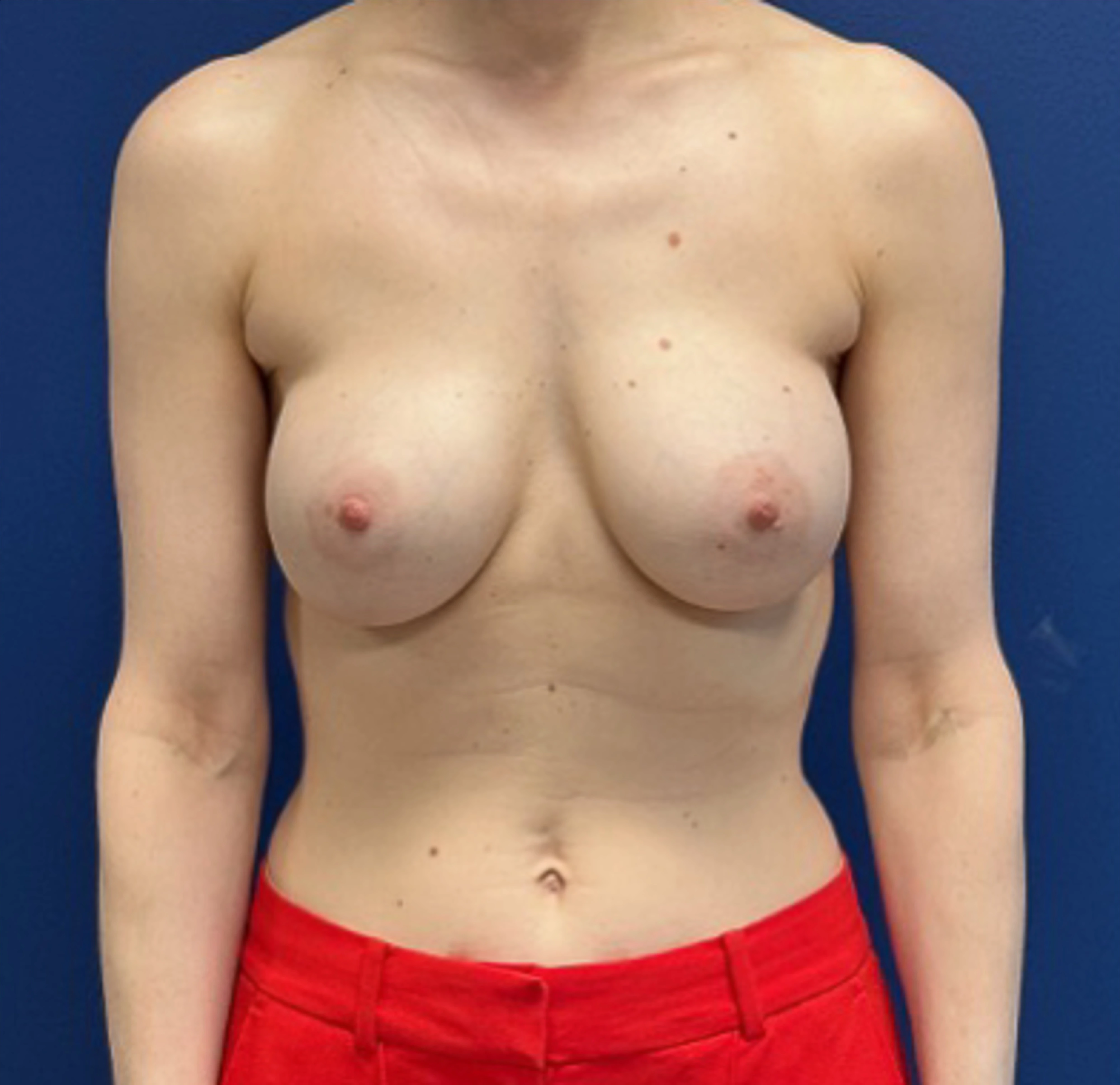 Revision-Augmentation-Case--26939 | Before Revision Augmentation 1