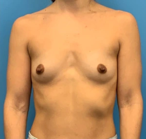 Breast-Augmentation-Case--24407 | Before Dr. Frank Albino 1