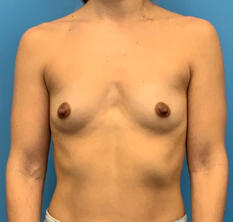 Breast-Augmentation-Case--24407 | Before Breast Augmentation 1