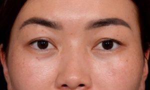 Blepharoplasty-Case--356 | Before Eyelid Surgery 1