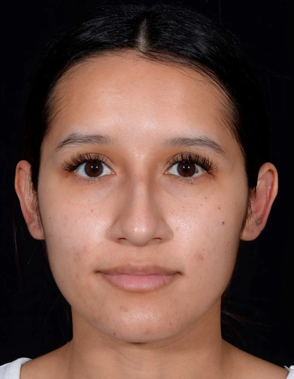 Rhinoplasty-Case--376 | Before Rhinoplasty 1