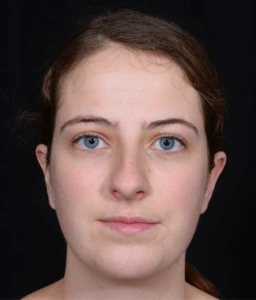 Rhinoplasty-and-Chin-Implant-Case--381 | Before Rhinoplasty 1