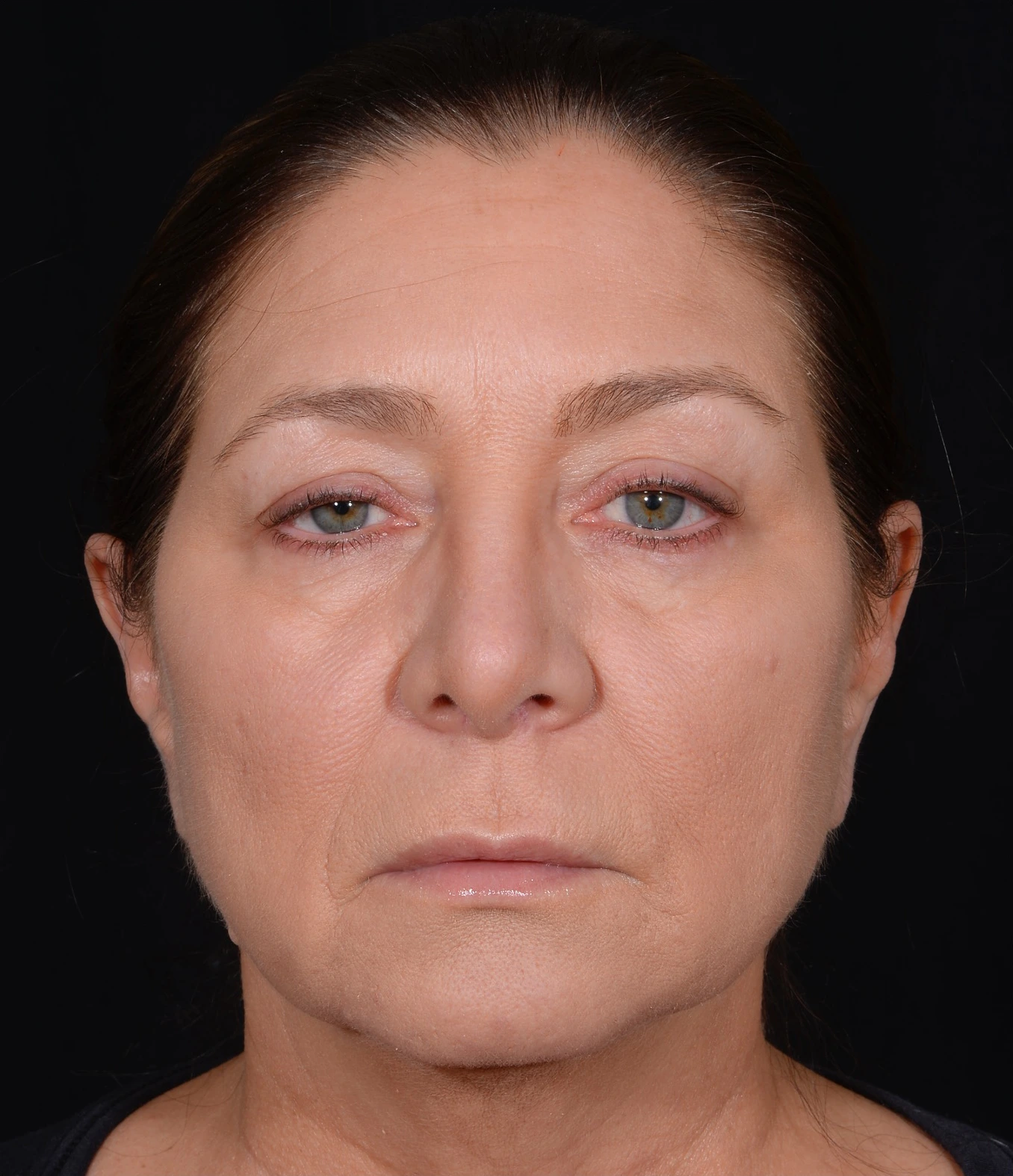 Quad-Blepharoplasty-Case--358 | Before Eyelid Surgery 1