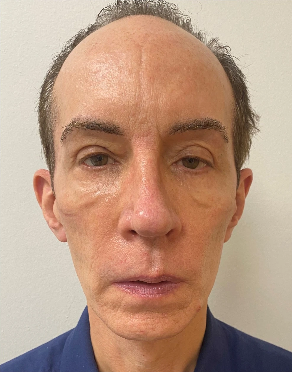 Quad-Blepharoplasty-Case--357 | Before Eyelid Surgery 1