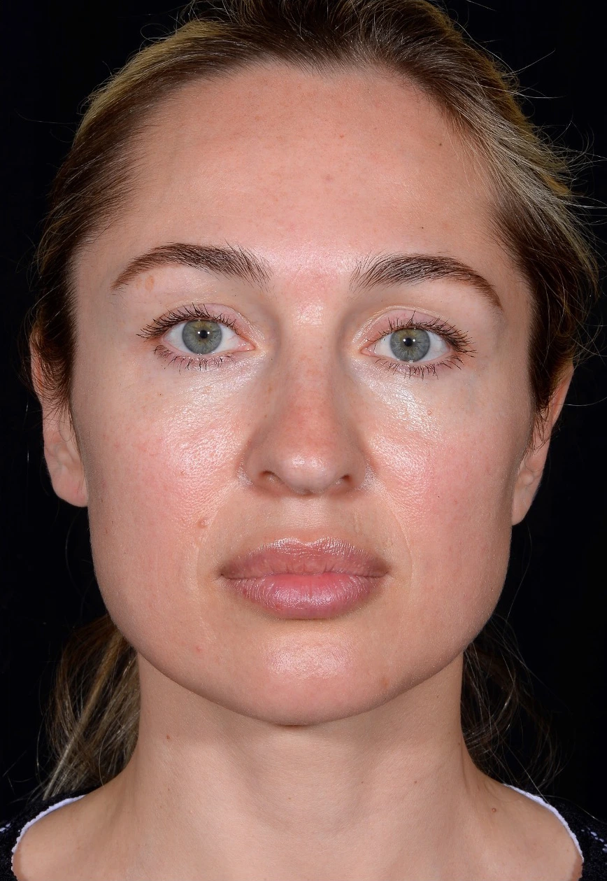 Rhinoplasty-Case--378 | Before Rhinoplasty 1