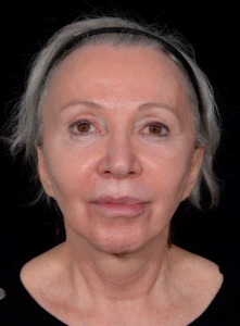 Facelift-Case--365 | Before Facelift 1