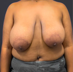 Breast-Reduction-Case--5320 | Before Dr. Arjun Kanuri 1