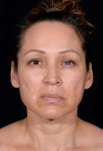 Facelift-Case--364 | Before Facelift 1