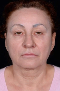Facelift-Case--363 | Before Facelift 1