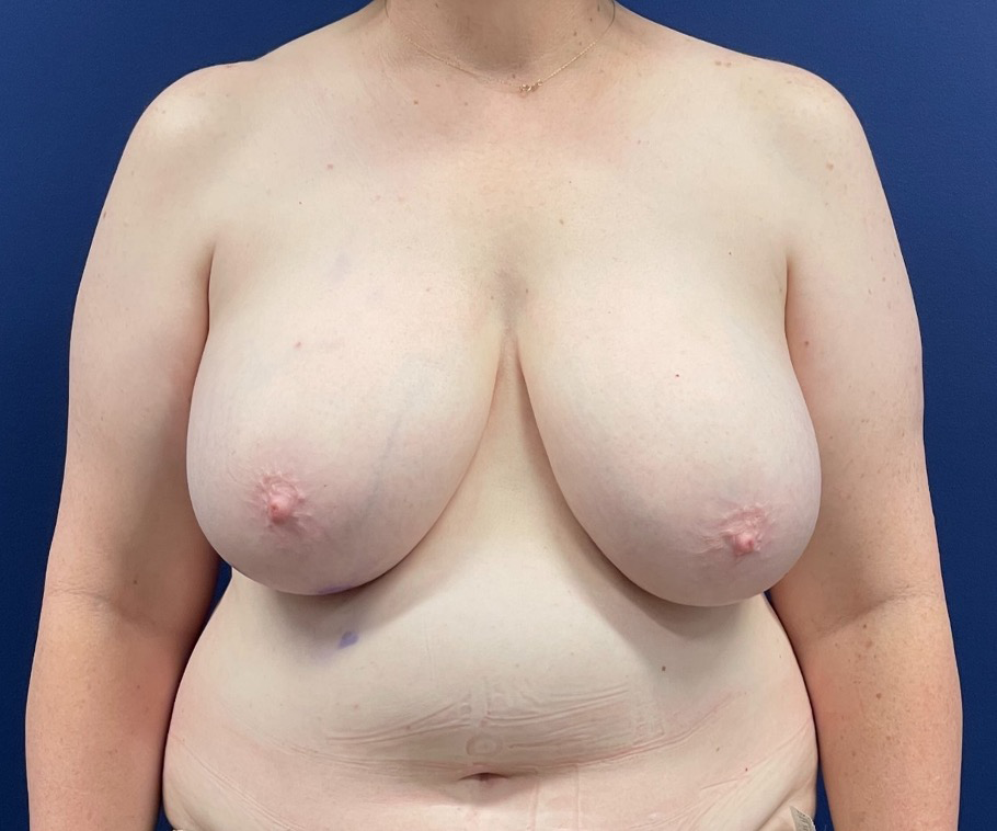 Breast-Reconstruction-DIEP-Flap-Case--26029 | Before Breast Reconstruction 1