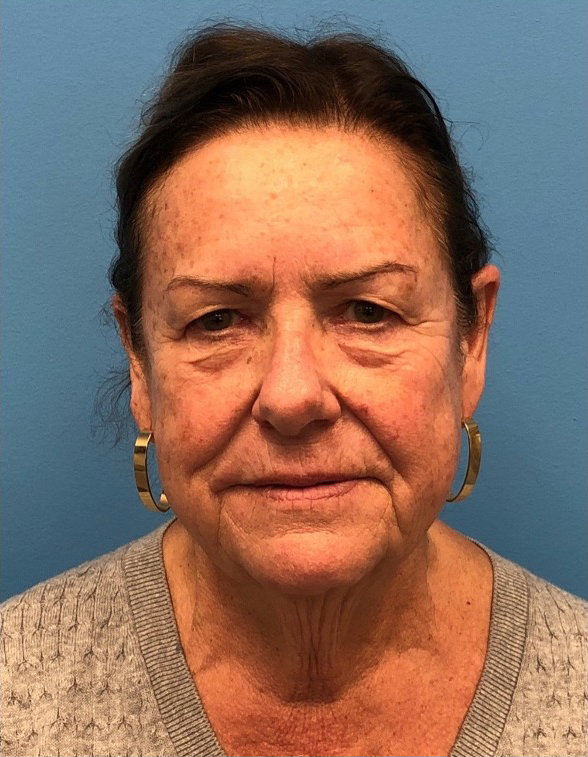 Facelift-Case--14406 | Before Eyelid Surgery 1