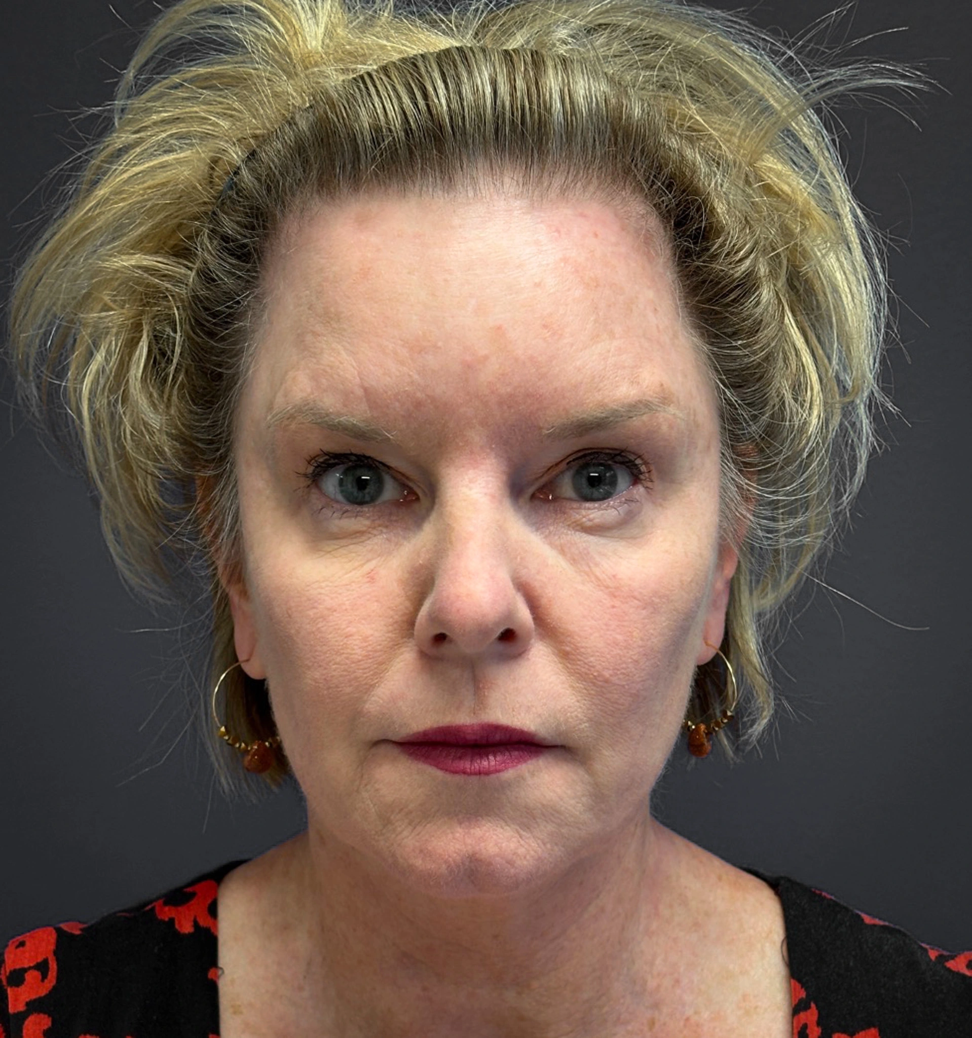 Blepharoplasty-Case--7015 | Before Eyelid Surgery 4