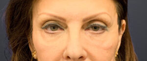 Blepharoplasty-Case--6272 | Before Eyelid Surgery 1