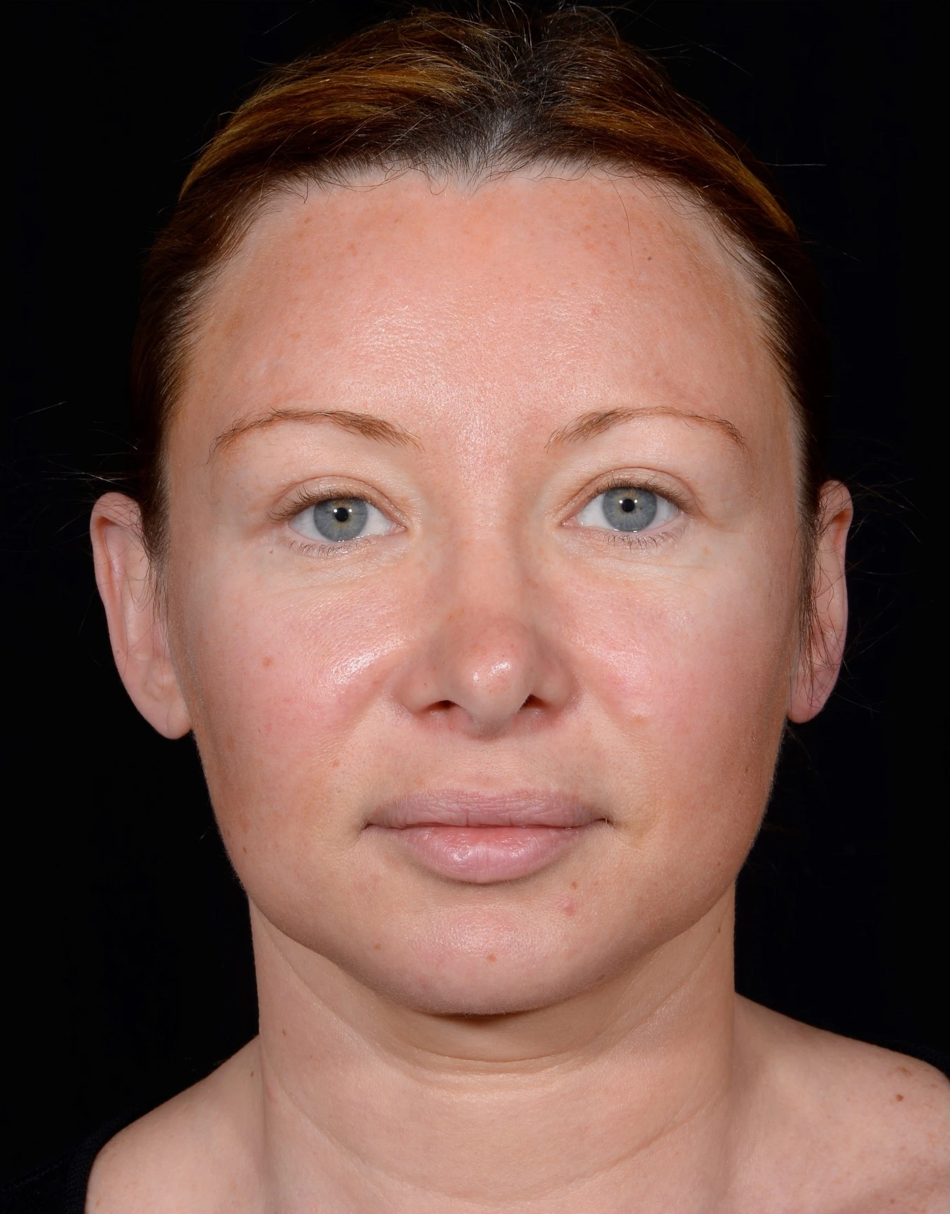 Facelift-Case--355 | Before Facelift 1