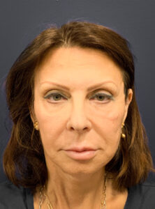 Blepharoplasty-Case--6272 | Before Eyelid Surgery 2
