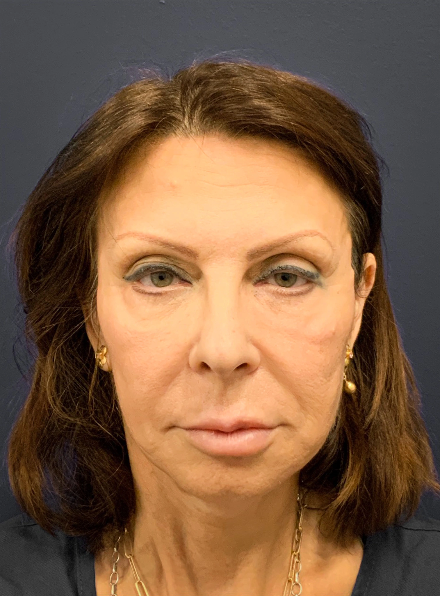 Blepharoplasty-Case--6272 | Before Eyelid Surgery 2
