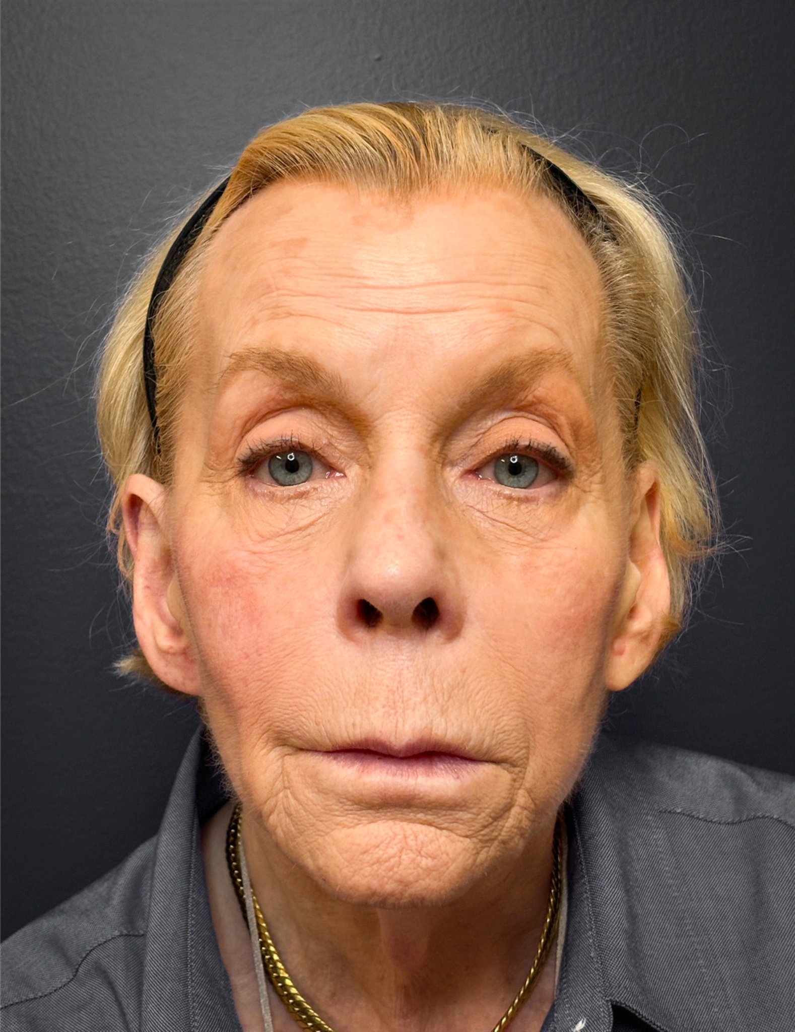 Facelift-Case--7247 | Before Facelift 1