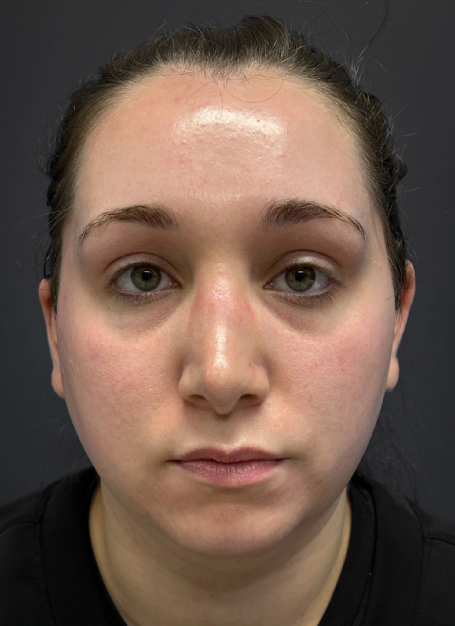 Submental-Liposuction-Case--3439 | Before Submental Liposuction 1