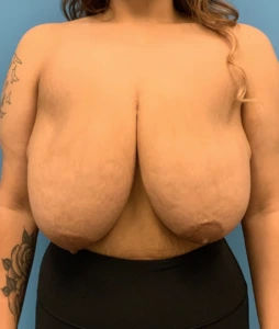 Breast-Reduction-Case--212 | Before Breast Reduction 1