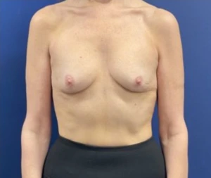 Subfascial-Breast-Augmentation-Case--26649 | Before Breast Augmentation 1