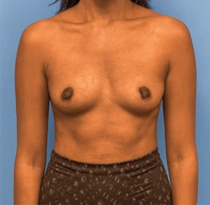 Breast-Augmentation-Case--25592 | Before Dr. Samir Rao 1