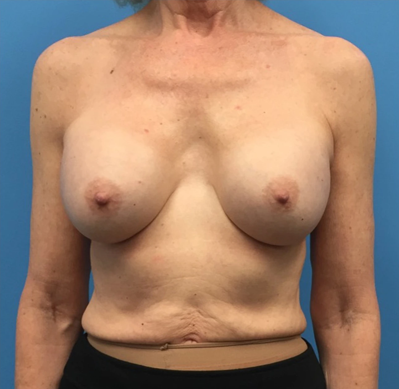 Revision-Breast-Augmentation-Case--237 | Before Revision Augmentation 1