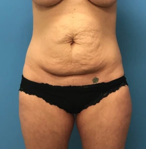Abdominoplasty-Flank-Liposuction-Case--244 | Before Liposuction 1