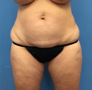 Case--248 | Before Liposuction 1