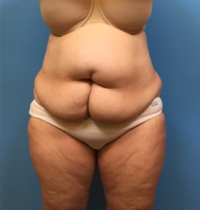 Case--249 | Before Liposuction 1