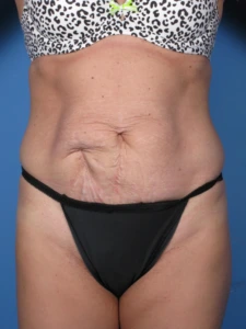 Tummy-Tuck-Case--250 | Before Tummy Tuck 1