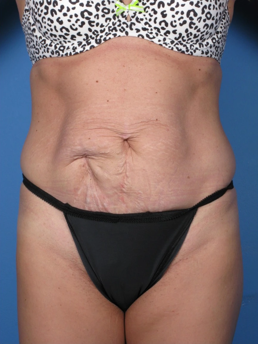 Tummy-Tuck-Case--250 | Before Tummy Tuck 1