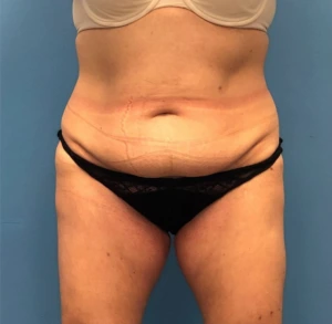 Case--251 | Before Liposuction 1