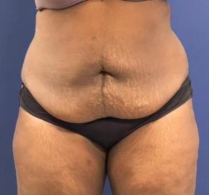 Case--257 | Before Liposuction 1