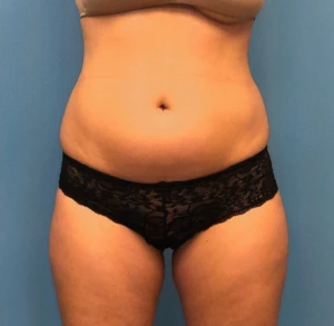 Lipo-360-Case--277 | Before Liposuction 1