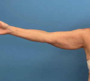 Liposuction-Case--23690-2 | Before Liposuction 2