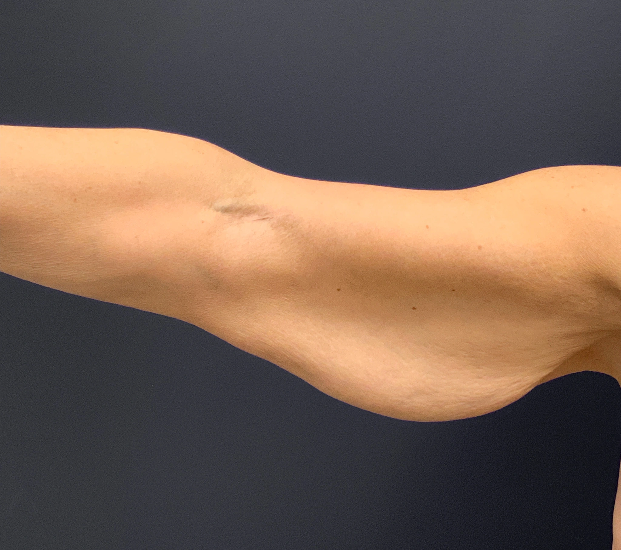 Brachioplasty-Case--6382 | Before Arm Lift 6