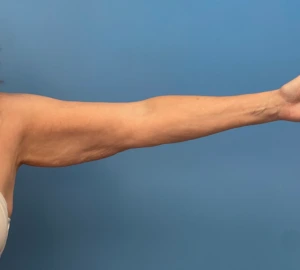 Liposuction-Case--23690-2 | Before Liposuction 1