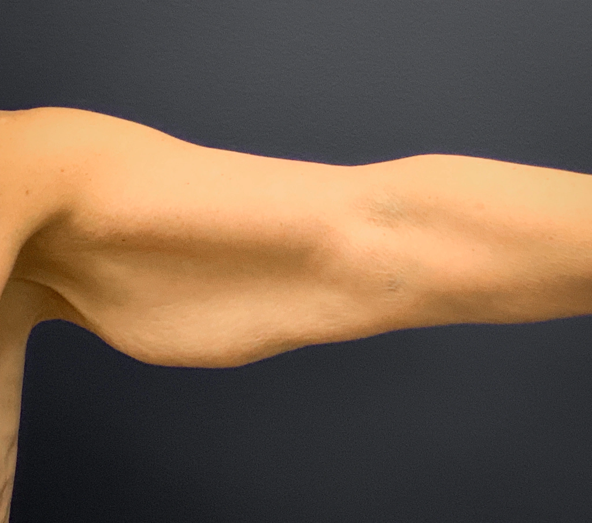 Brachioplasty-Case--6382 | Before Arm Lift 5