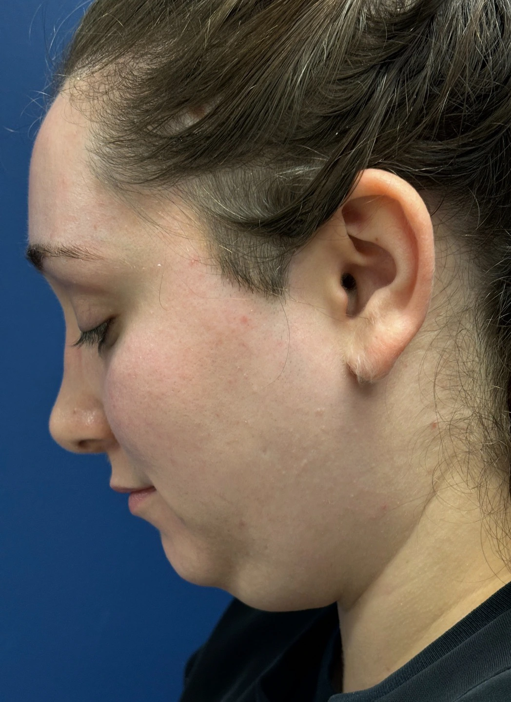 Submental-Liposuction-Case--29107 | Before Submental Liposuction 4