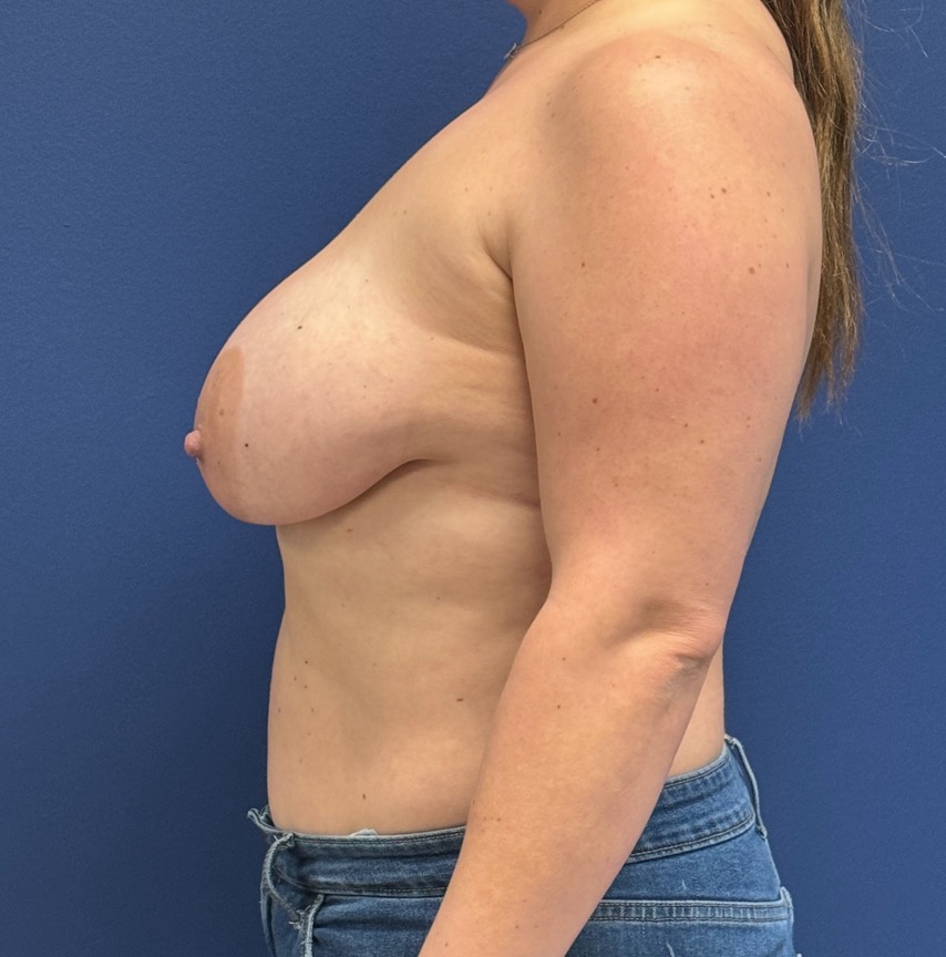 Breast-Augmentation-Mastopexy-Case--29079 | Before Breast Augmentation With Lift 4