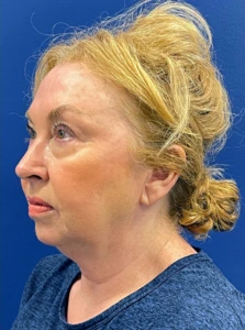 Facelift-Case--22860 | Before Facelift 2