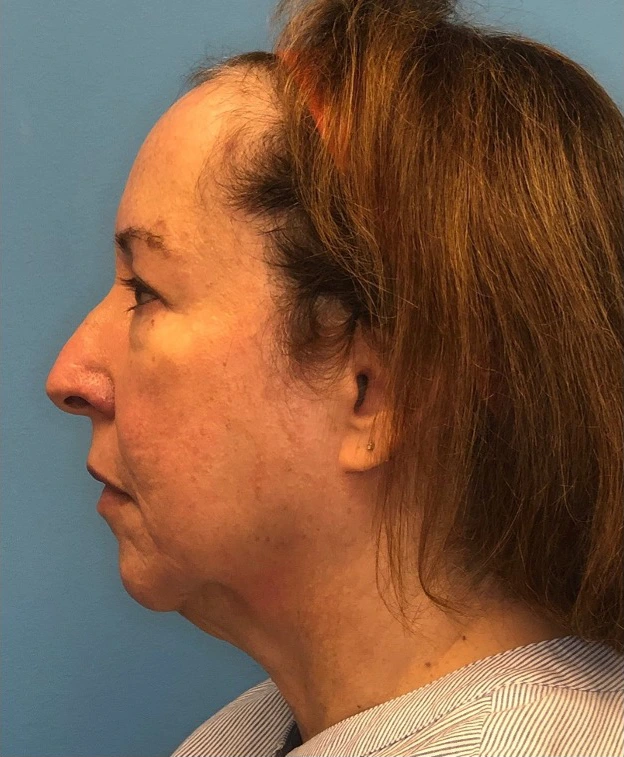 Facelift-Case--21241 | Before Facelift 3