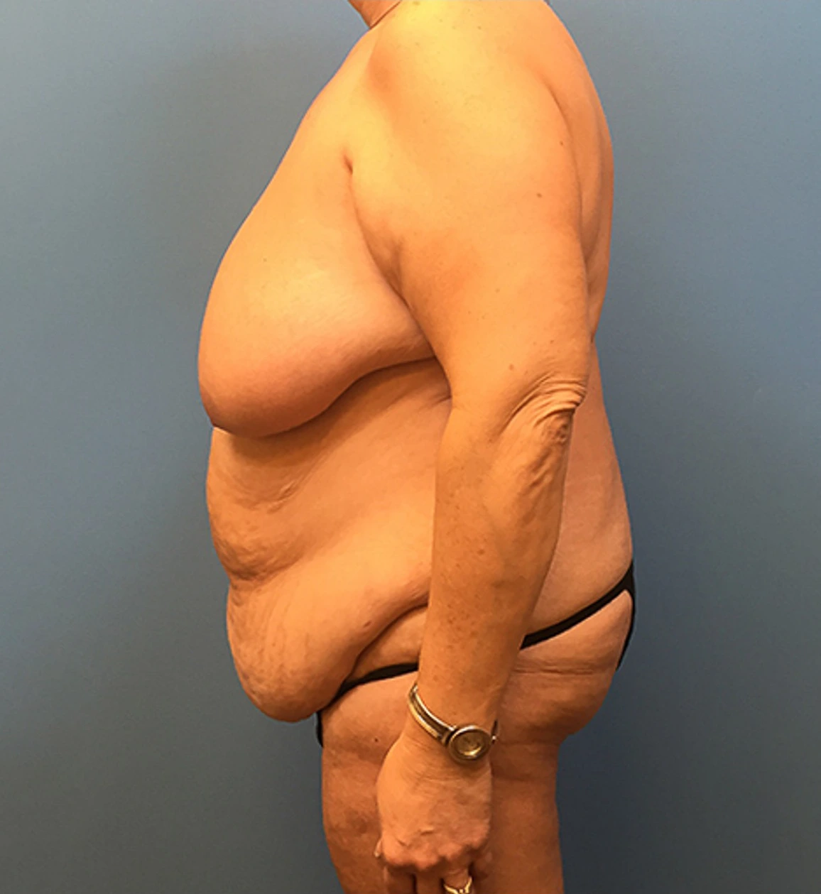 Mommy-Makeover-Case--39 | Before Mommy Makeover 3