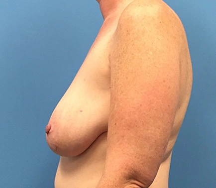 Case--137 | Before Breast Reconstruction 2