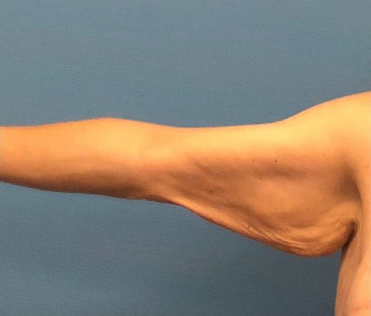 Brachioplasty-Arm-Lift-Case--18182 | Before Arm Lift 1