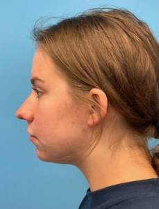 Rhinoplasty-Septoplasty-Case--23611 | Before Rhinoplasty 1